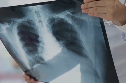 Image for Le Défi de l’innovation contre le cancer du poumon